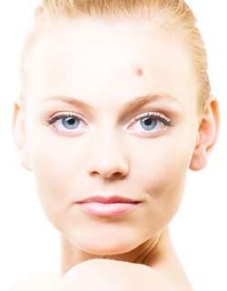 Acne em adultos Acne em adultos