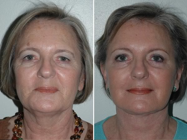 Vacuoterapia - Antes e depois Vacuoterapia - Antes e depois