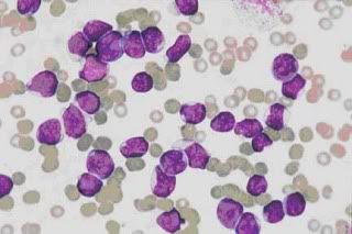 Leucemia Leucemia