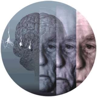 Mal de Alzheimer Mal de Alzheimer