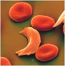 Anemia falciforme - Sintomas Anemia falciforme - Sintomas