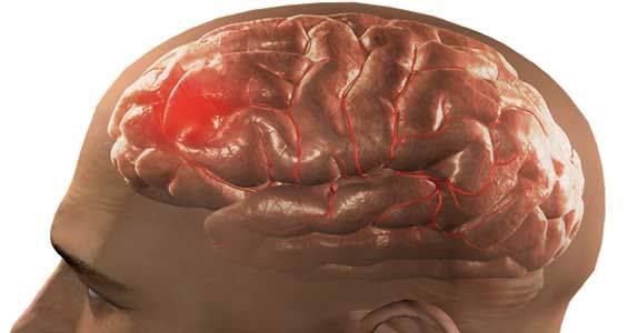 Derrame cerebral Derrame cerebral