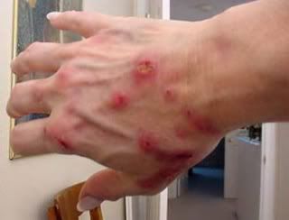 Doença de Morgellons nas mãos Doença de Morgellons nas mãos